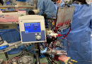 Innovazione in Cardiochirurgia a Catanzaro: L’Introduzione della Mini Circolazione Extracorporea